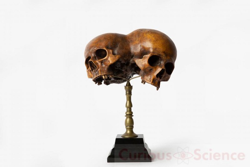 Conjoined Skull Model On Stand